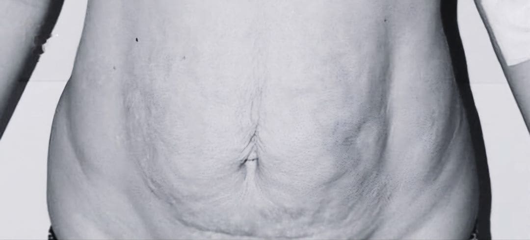 Fotografia prima dell’intervento di Addominoplastica.