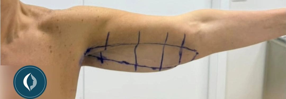 Fotografia prima dell’intervento di Lifting delle braccia.