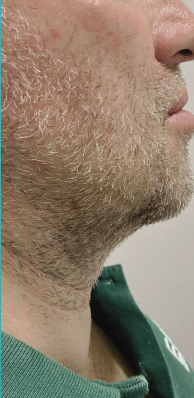 Fotografia dopo l’intervento di Liposuzione.