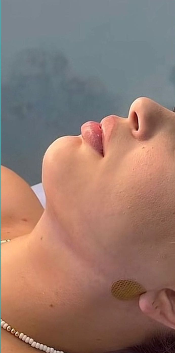 Fotografia dopo l’intervento di Liposuzione.