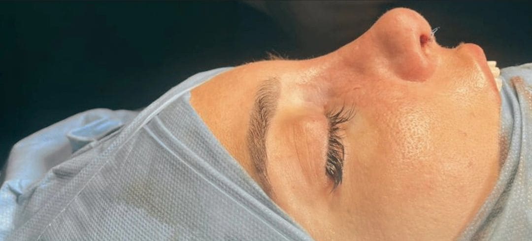 Fotografia dopo l’intervento di Rinoplastica.