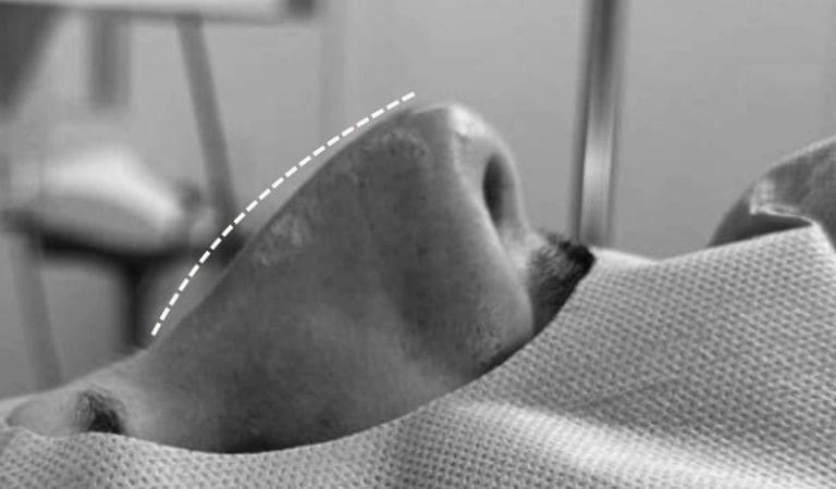Fotografia prima dell’intervento di Rinoplastica.