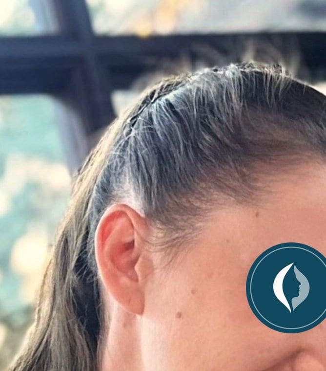 Fotografia dopo l’intervento di Trapianto di capelli.