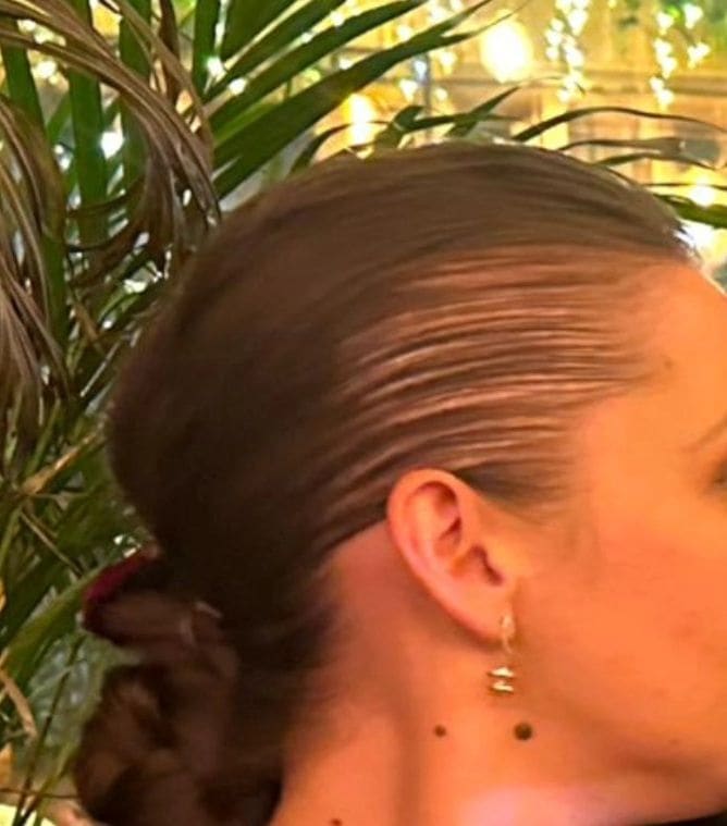Fotografia prima dell’intervento di Trapianto di capelli.